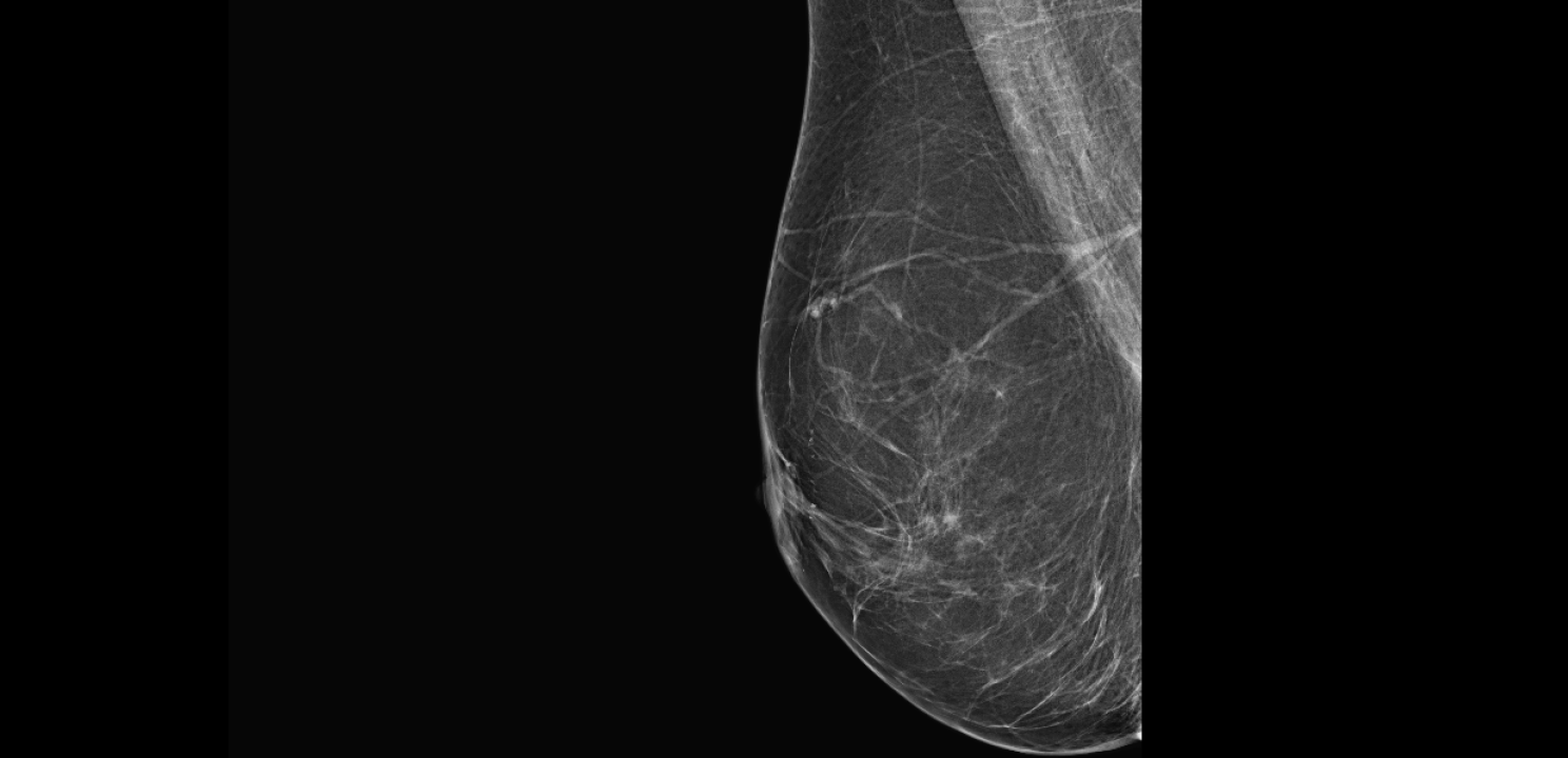 Poliklinika Affidea Vita svojim pacijenticama nudi besplatne preglede dojki! 