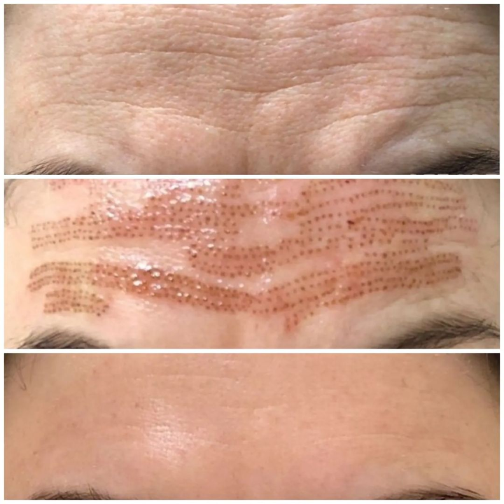 Uz Glam by Ana uklonite trajnu šminku i tetovaže bez boli!