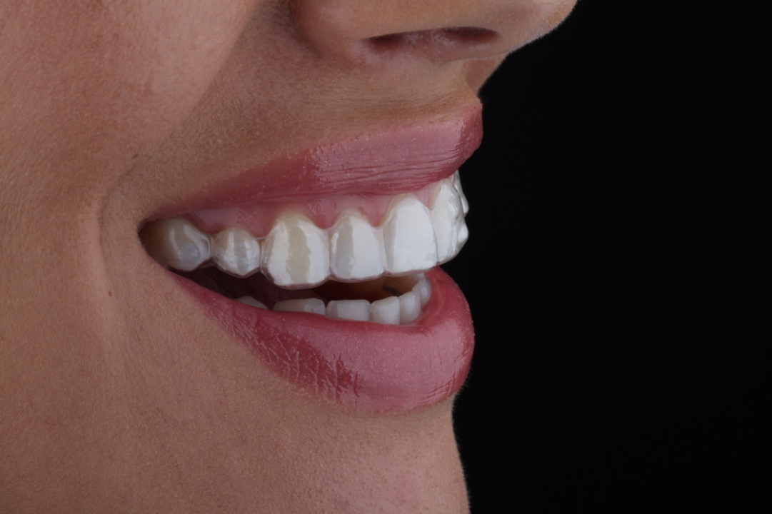 FOTO Saznajte sve o prozirnim aparatićima na Danima otvorenih vrata Dental centra Dubravica!