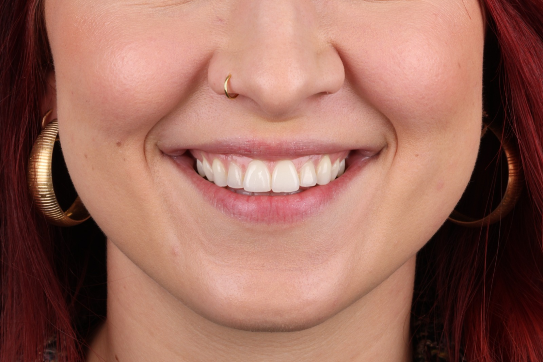 FOTO Transformirajte osmijeh prozirnim alignerima u Dental centru Dubravica! 	