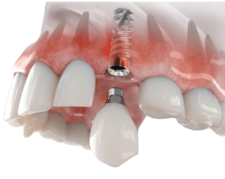 FOTO Životna prekretnica uz Dental centar Dubravica: Što trebate znati prije ugradnje implantata